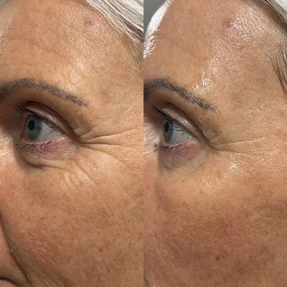 NUKO® Carboxy Therapy