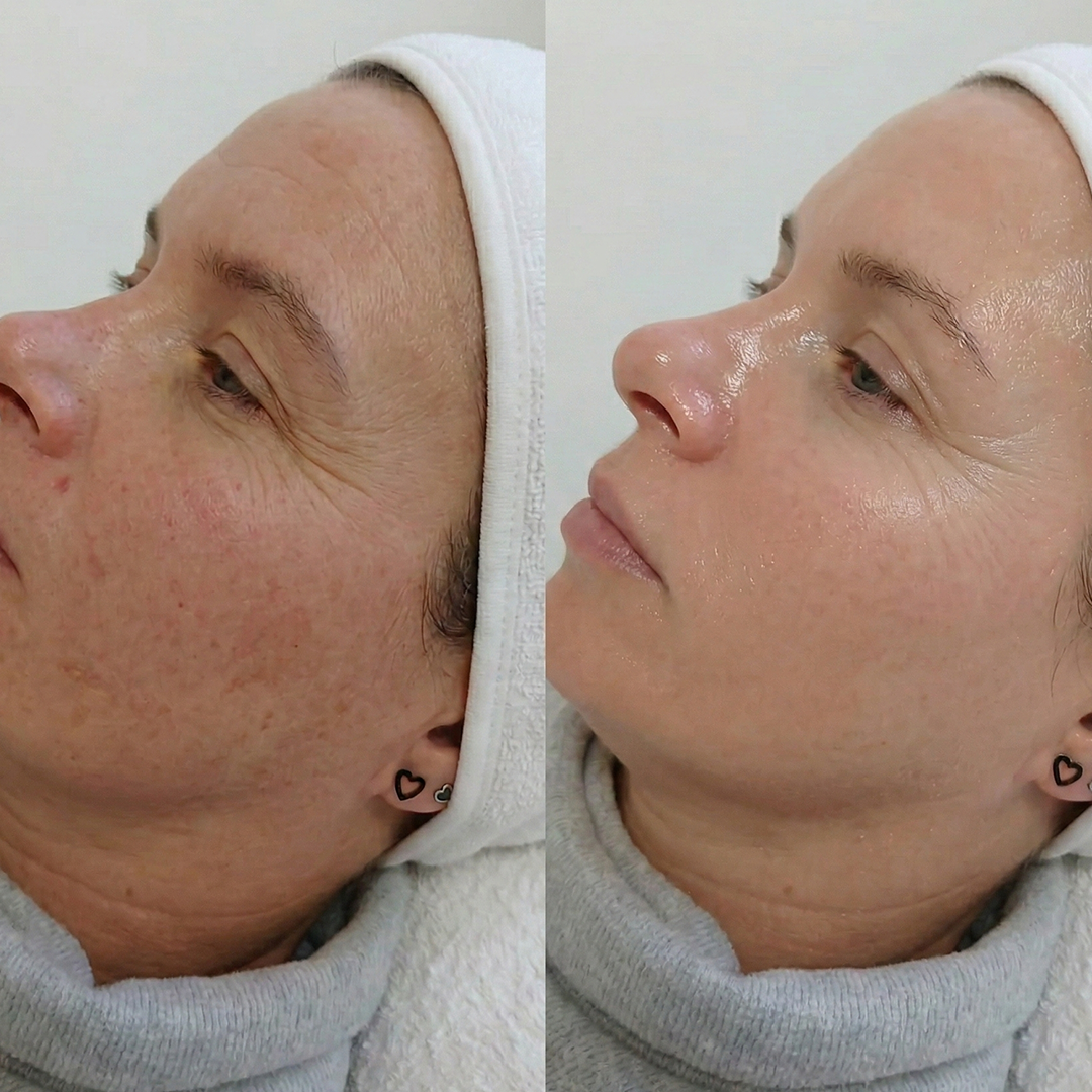 NUKO® Carboxy Therapy